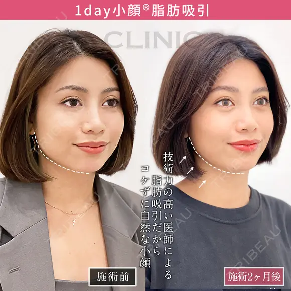 【1day小顔】お顔の余白が少なくなり自然に垢抜け♪ before画像 メイン用