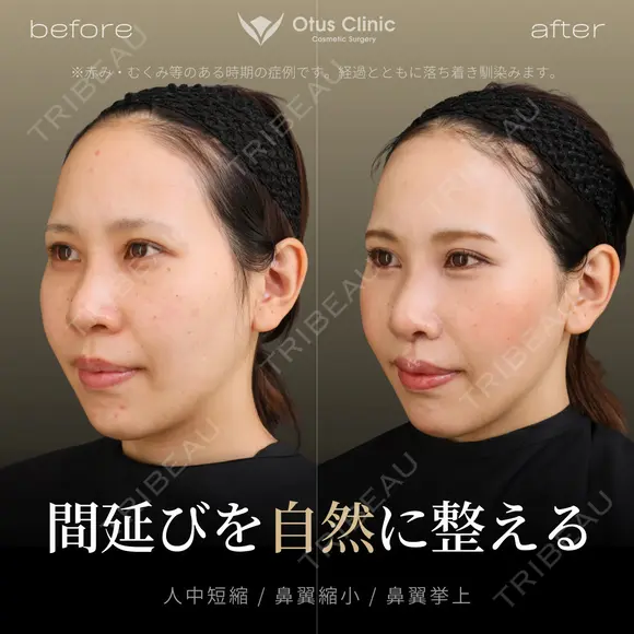 人中短縮・鼻翼縮小・鼻翼挙上 before画像 メイン用