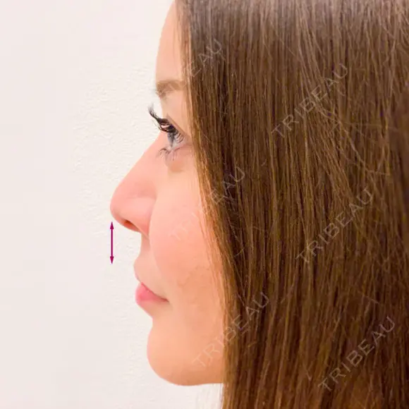 人中短縮で美人顔を手に入れる♪【ヒアルロン酸鼻中隔延長・人中短縮】 before画像 メイン用