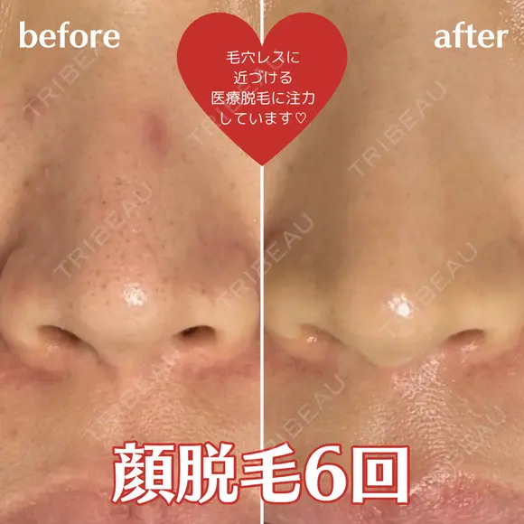 顔脱毛６回 before画像 メイン用
