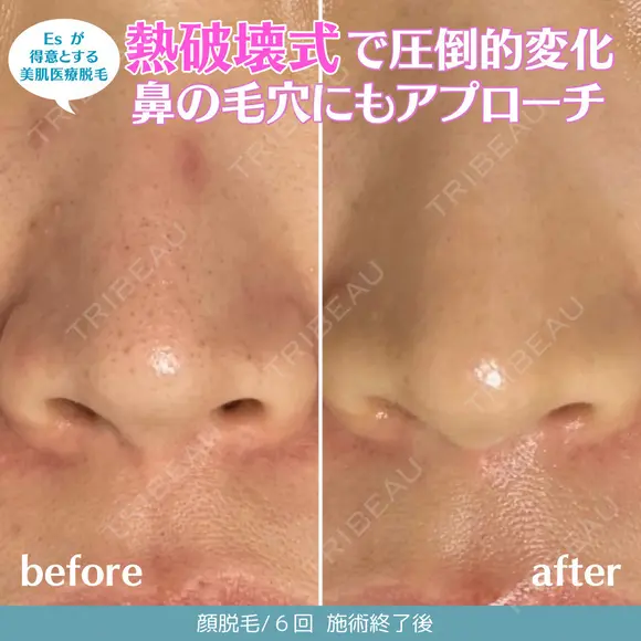 顔脱毛６回 180日後 メイン用