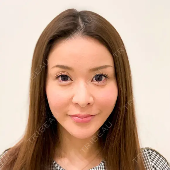 人中短縮で美人顔を手に入れる♪【ヒアルロン酸鼻中隔延長・人中短縮】 after画像 メイン用