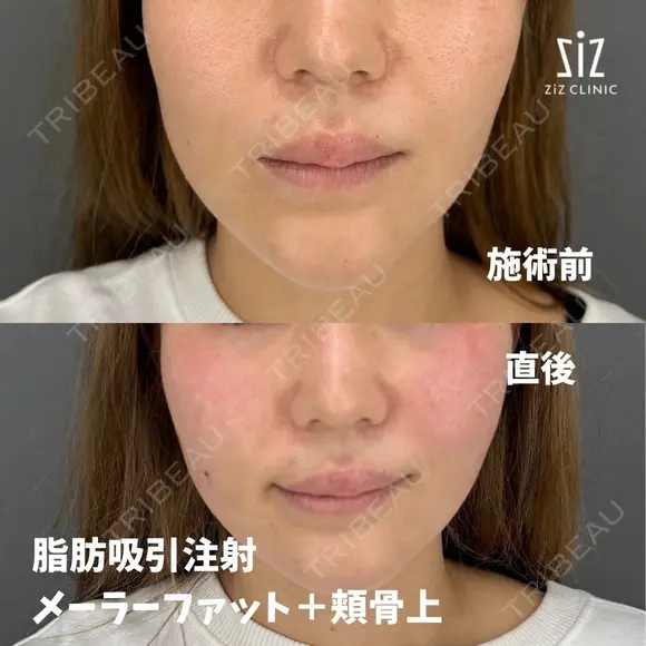 笑った時の頬の盛り上がりが気になる33歳女性の脂肪吸引注射 after画像 メイン用