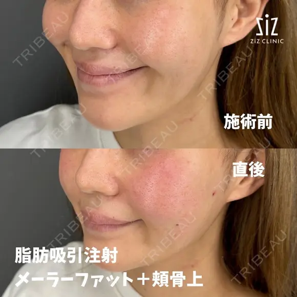 笑った時の頬の盛り上がりが気になる33歳女性の脂肪吸引注射 after画像 メイン用