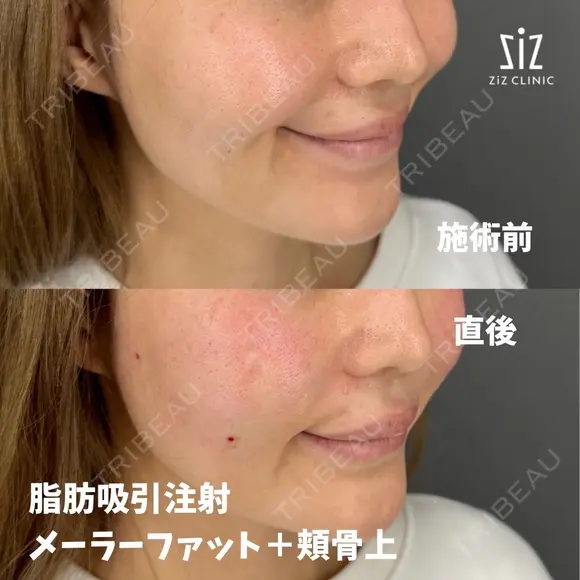 笑った時の頬の盛り上がりが気になる33歳女性の脂肪吸引注射 after画像 メイン用