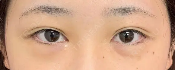 『　たるみ取り併用全切開法二重術　』『　ＧＢＣ式韓流目頭切開　』『　下眼瞼下制術  （タレ目、グラマラスライン形成）』 before画像 メイン用