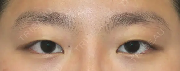 目力アップ+マイクロ脱脂+埋没法 before画像 メイン用