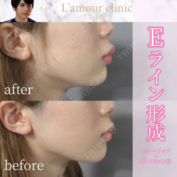 Eライン形成 after画像 メイン用