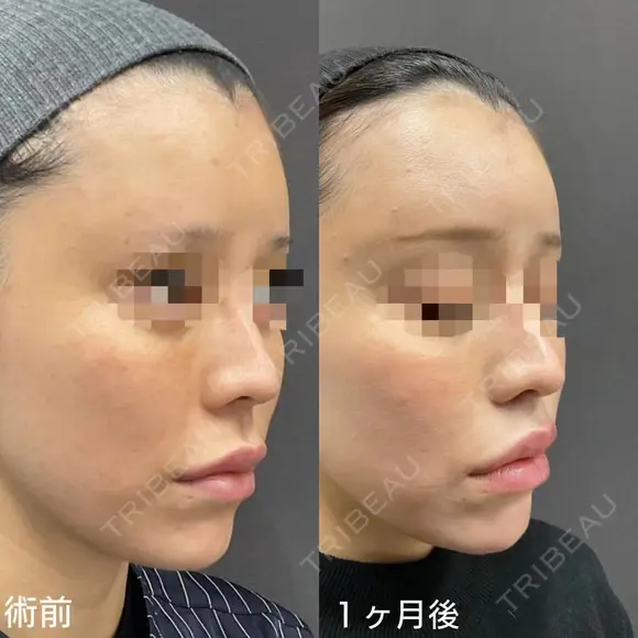魅惑的な口元に💋人中短縮 30日後 メイン用