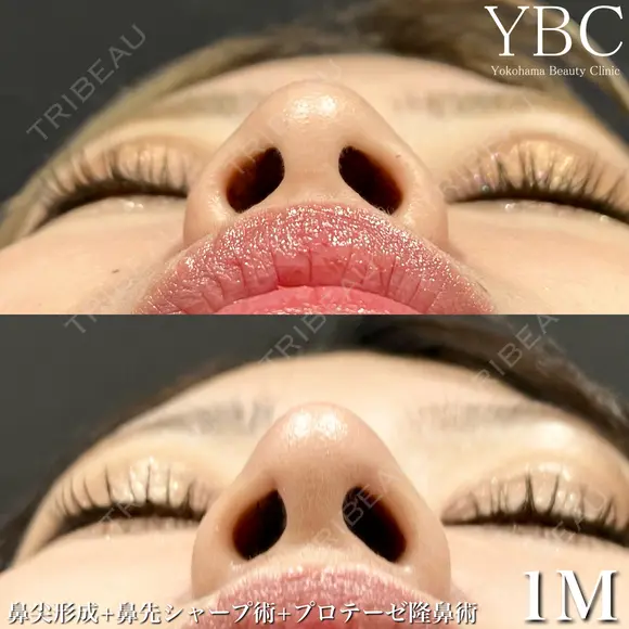 【⛄プロテーゼ隆鼻術⛄】 before画像 メイン用