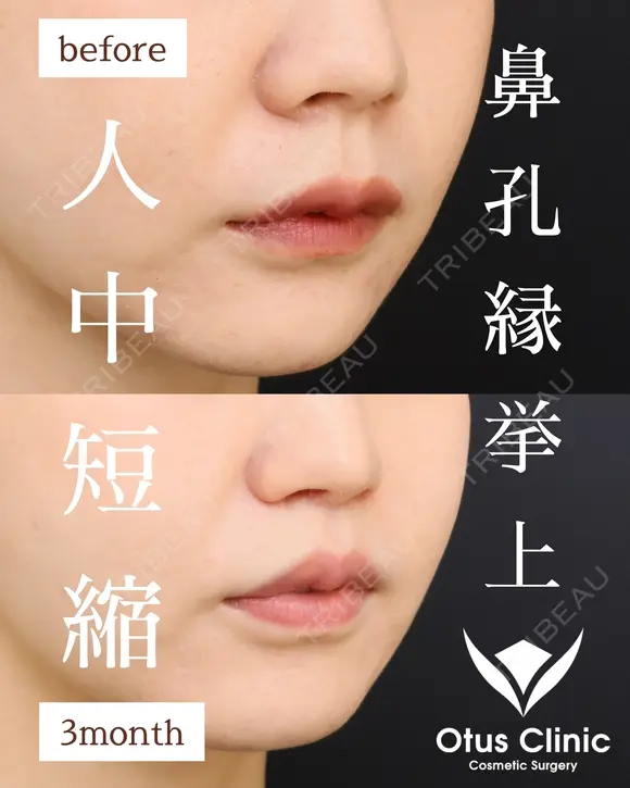 鼻孔縁挙上・人中短縮・小鼻縮小・鼻翼挙上 before画像 メイン用