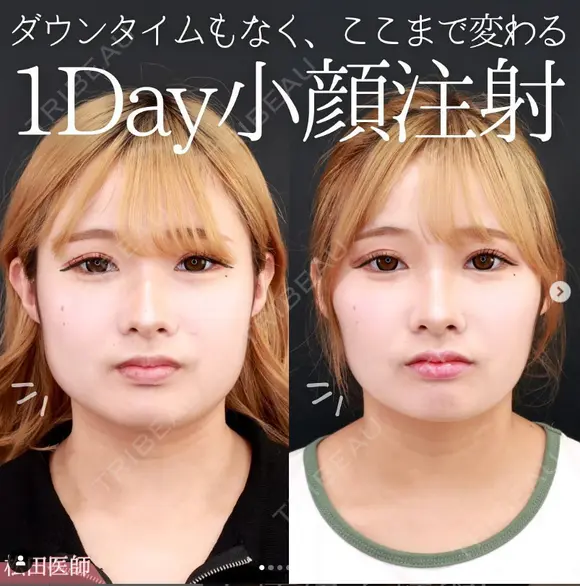 エラボトックス after画像 メイン用
