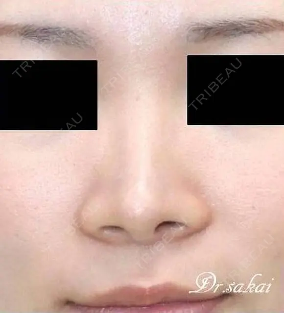 鼻尖縮小術+耳介軟骨移植 180日後 メイン用