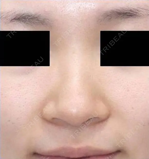 鼻尖縮小術+耳介軟骨移植 before画像 メイン用