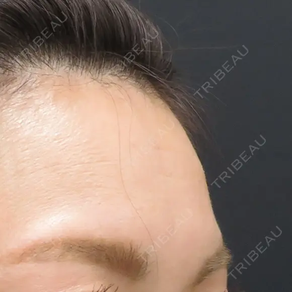 ぷるぷる注射 before画像 メイン用