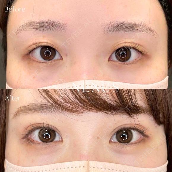 ネクサスアイズ(埋没法) after画像 メイン用