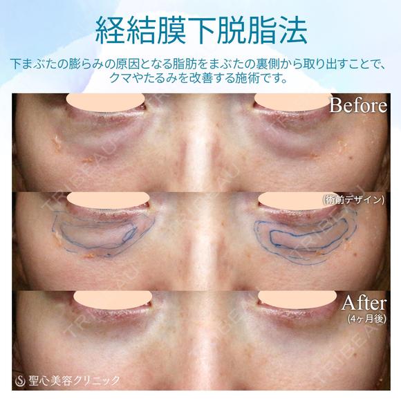 【40代女性・目の下のクマを切らずに解消】経結膜下脱脂術単独（4ヶ月後） before画像 メイン用