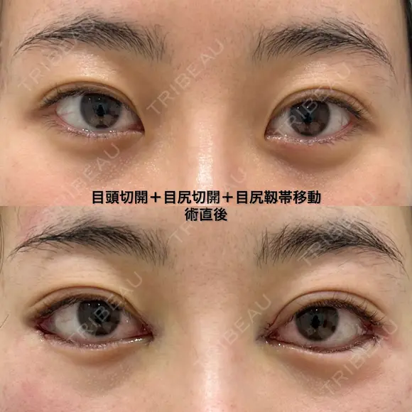 目頭切開＋目尻切開＋目尻靱帯移動 before画像 メイン用