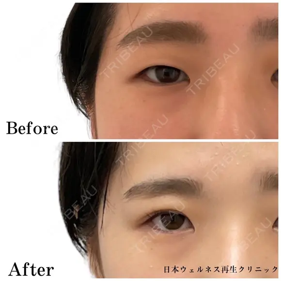 二重埋没法 after画像 メイン用