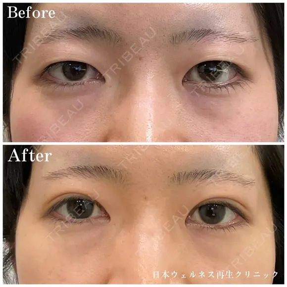 二重埋没法 before画像 メイン用