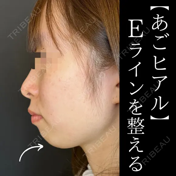 顎ヒアルロン酸（ボラックス） before画像 メイン用