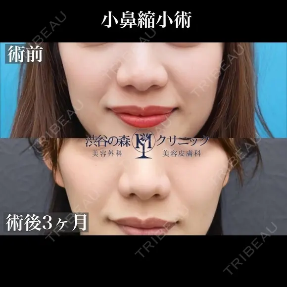 小鼻縮小（内側＋外側切開） before画像 メイン用