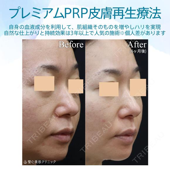 【40代女性・目の下とほうれい線で自然に若返り】プレミアムPRP皮膚再生療法（半年後） after画像 メイン用