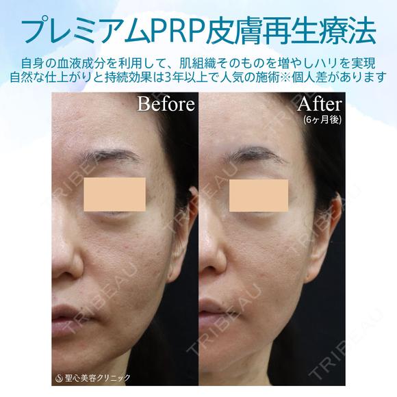 【40代女性・目の下とほうれい線で自然に若返り】プレミアムPRP皮膚再生療法（半年後） after画像 メイン用