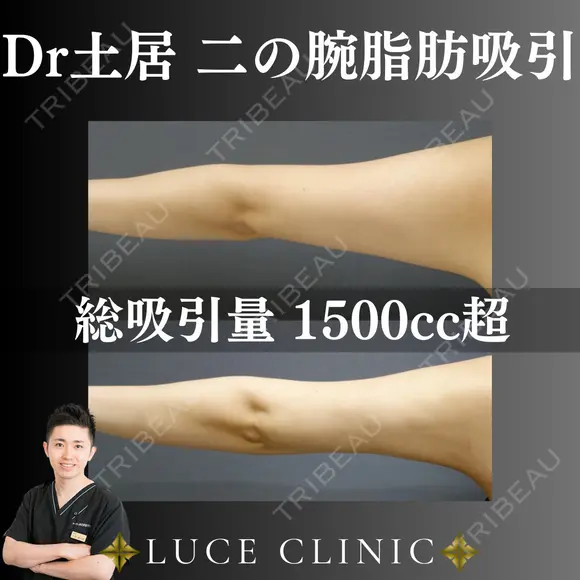 二の腕脂肪吸引 before画像 メイン用