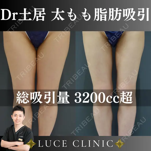 大腿脂肪吸引 after画像 メイン用