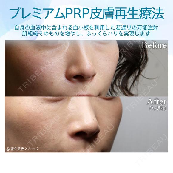 【30代女性・目の下、ほうれい線をナチュラルに目立たなく】プレミアムPRP皮膚再生療法（術後3ヶ月） 90日後 メイン用
