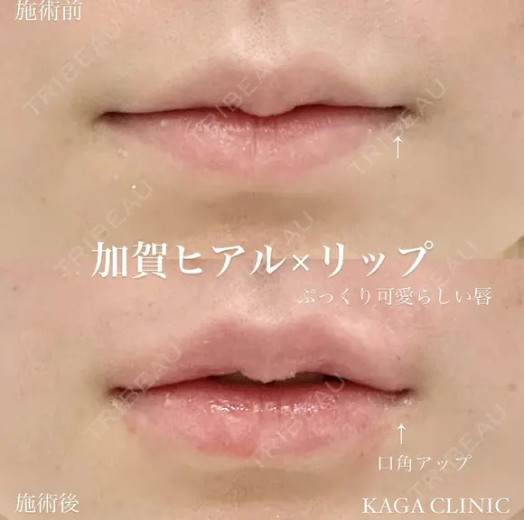加賀ヒアル×リップ after画像 メイン用