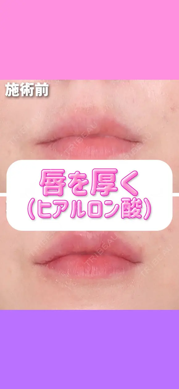 唇を厚く（ヒアルロン酸） after画像 メイン用