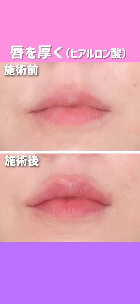 唇を厚く（ヒアルロン酸） after画像 メイン用