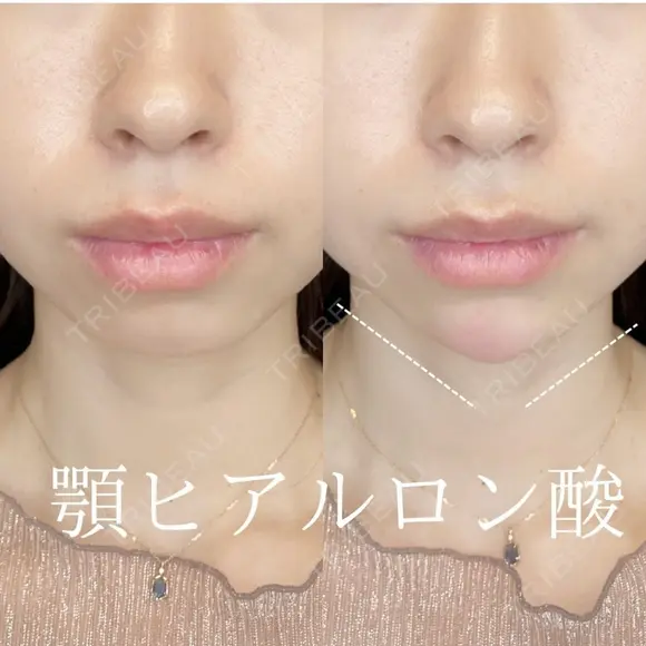 あごヒアルロン酸 after画像 メイン用