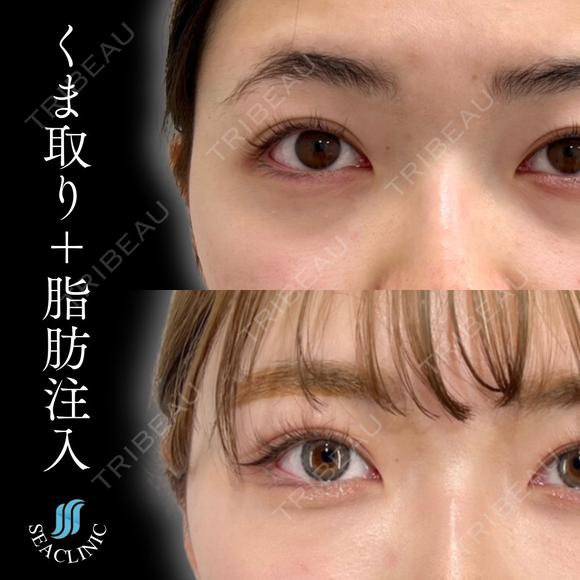目の下のクマ取り＋脂肪注入 before画像 メイン用