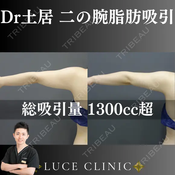 二の腕脂肪吸引 after画像 メイン用