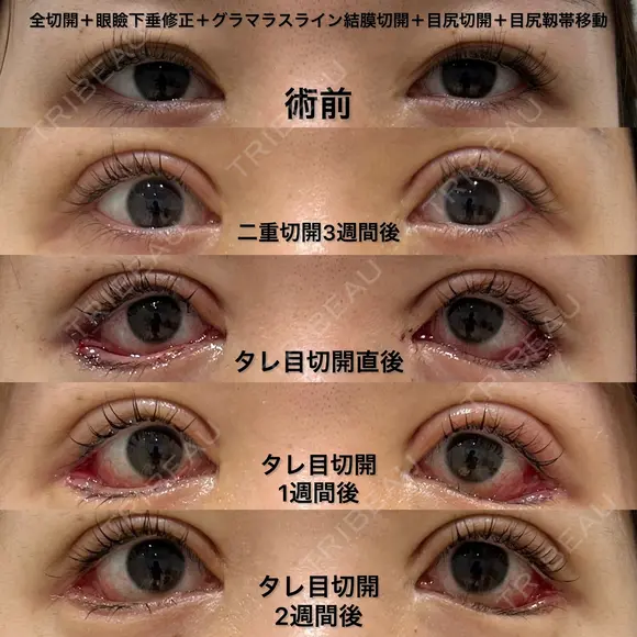 全切開＋眼瞼下垂修正＋グラマラスライン結膜切開＋目尻切開＋目尻靱帯移動＋裏ハムラ 14日後 メイン用