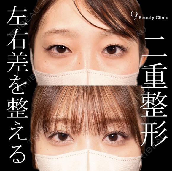 二重埋没 after画像 メイン用