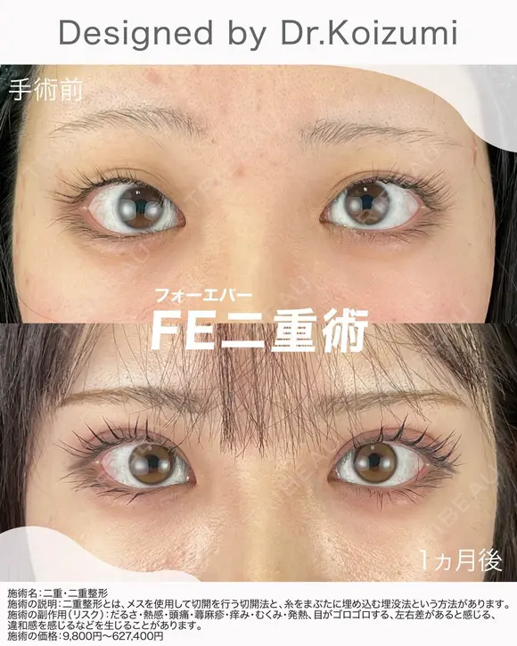 フォーエバー二重術 before画像 メイン用