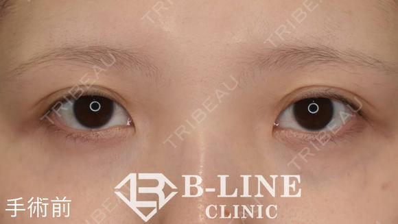 【目頭切開術(Z形成)】 手術直後 before画像 メイン用