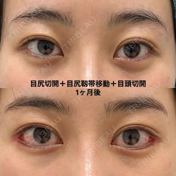 目頭切開＋目尻切開＋目尻靱帯移動 30日後 メイン用
