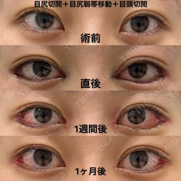 目頭切開＋目尻切開＋目尻靱帯移動 after画像 メイン用