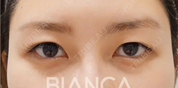 皮膚を持ち上げ平行二重へ before画像 メイン用
