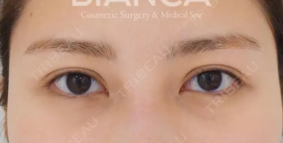 皮膚を持ち上げ平行二重へ after画像 メイン用