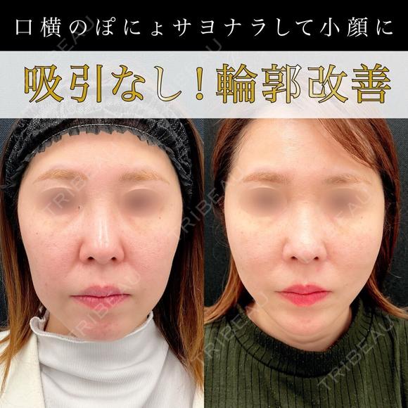 アプリリフト12本＋ヒアルロン酸(頬＋法令線＋あご)＋ボツリヌス注射(あご) 14日後 メイン用