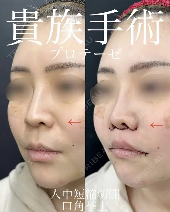 人中短縮、口角挙上、貴族手術 0日後 メイン用