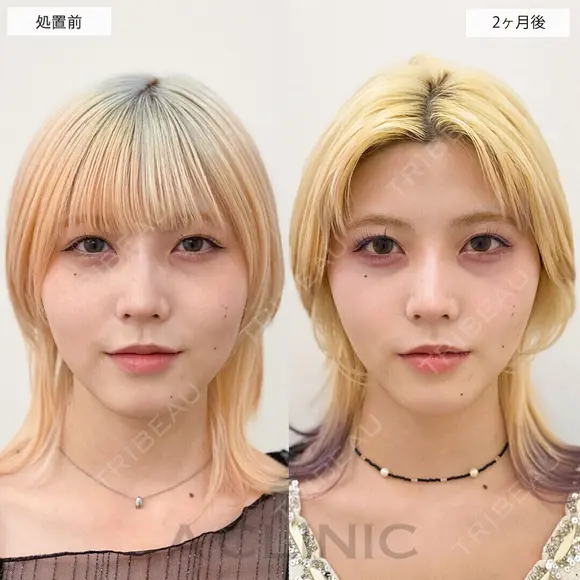 【1day小顔】2ヶ月後には理想のVフェイスが完成！処置前と2ヶ月後の症例です before画像 メイン用