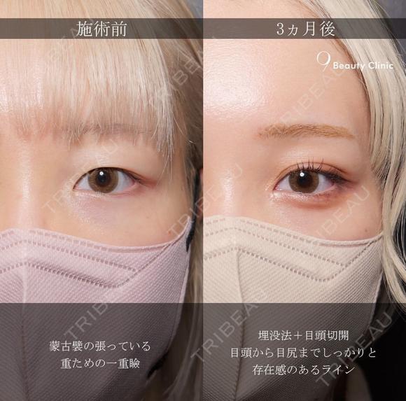 二重埋没・目頭切開 before画像 メイン用
