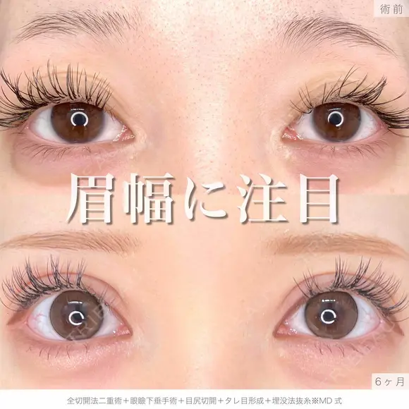全切開法二重術＋眼瞼下垂手術+目尻切開＋タレ目形成＋埋没法抜糸※MD式 before画像 メイン用